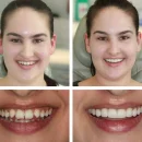 Transforming Smiles with Composite Bonding: An Innovative Approach