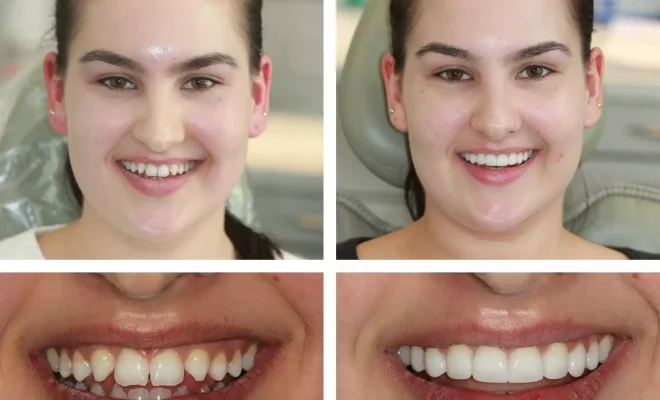 Transforming Smiles with Composite Bonding: An Innovative Approach