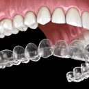 Revolutionising Orthodontics: The Future of Invisalign in Dentistry