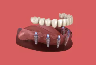 How Dental Implants Restore Bite Force and Transform Your Eating Experience