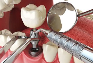 How Dental Implants Support Adjacent Teeth and Prevent Shifting Over Time