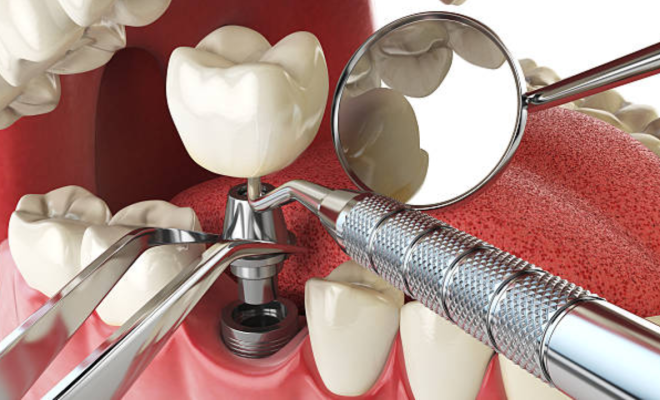 How Dental Implants Support Adjacent Teeth and Prevent Shifting Over Time