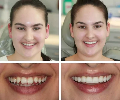 Transforming Smiles with Composite Bonding: An Innovative Approach