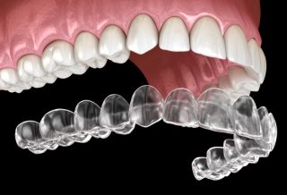 Revolutionising Orthodontics: The Future of Invisalign in Dentistry