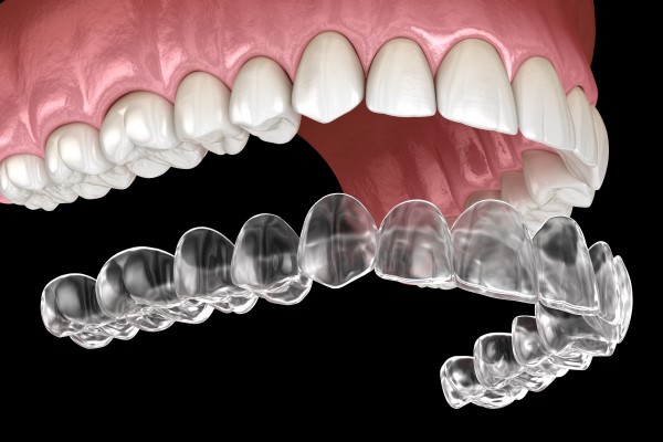 Revolutionising Orthodontics: The Future of Invisalign in Dentistry