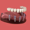 How Dental Implants Restore Bite Force and Transform Your Eating Experience