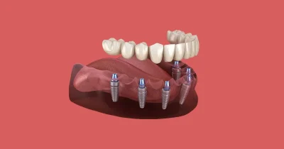 How Dental Implants Restore Bite Force and Transform Your Eating Experience