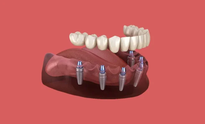 How Dental Implants Restore Bite Force and Transform Your Eating Experience