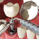 How Dental Implants Support Adjacent Teeth and Prevent Shifting Over Time